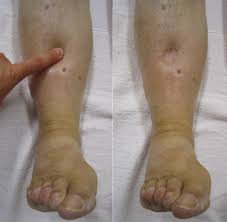 Illustration showing swelling of tissues due to edema