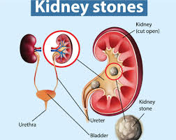 Kidney Stone