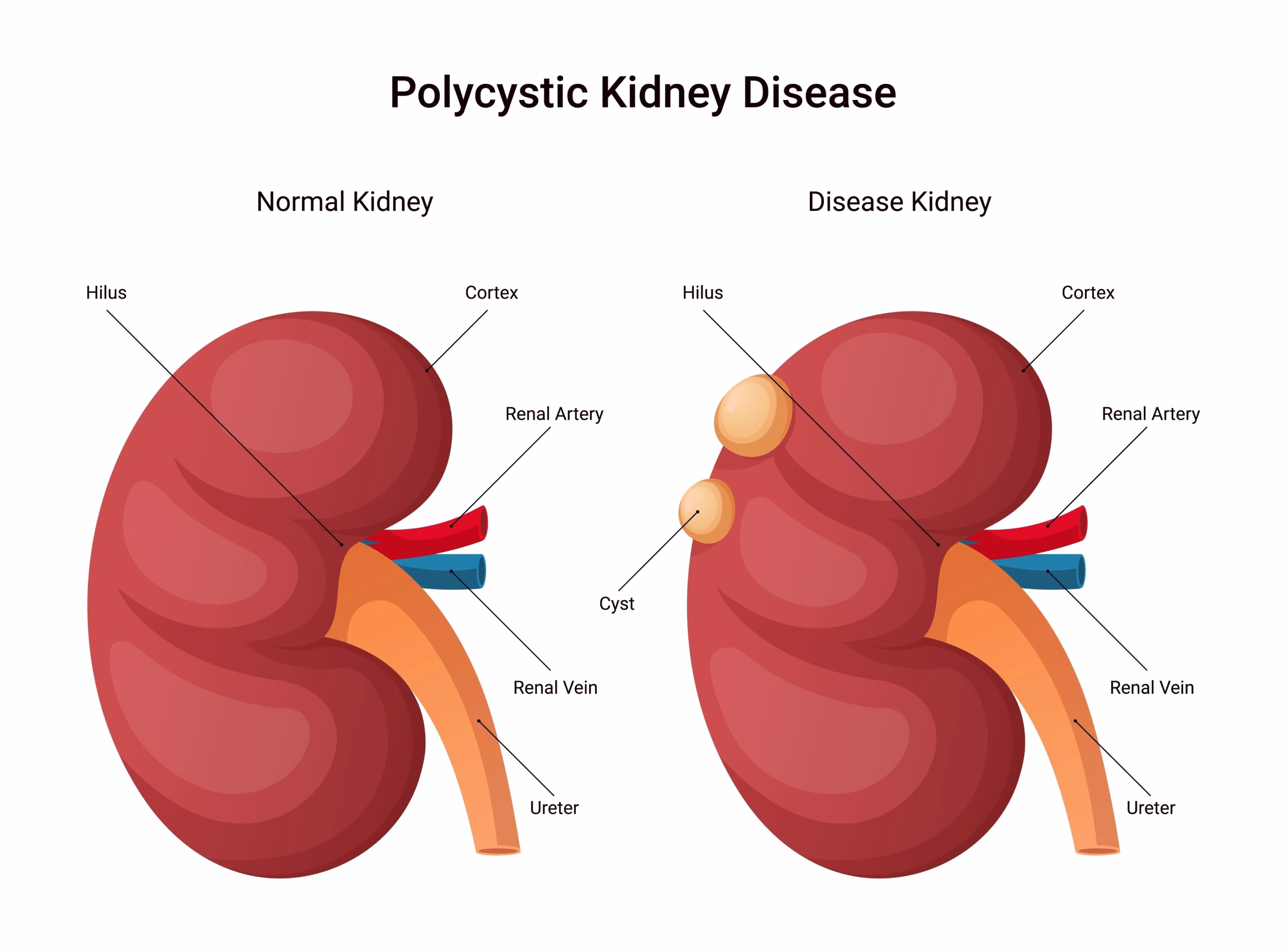 Polycystic Kidney Disease Illustration